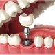 ایمپلنت در کلینیک دندان پزشکی خوب