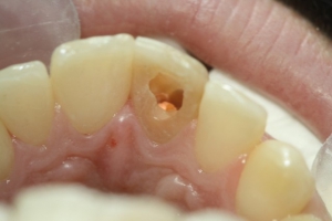 بلیچینگ  دندان عصب کشی شده