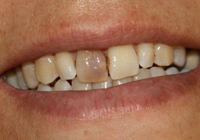 بلیچینگ  داخلی دندان عصب کشی شده