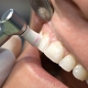 بروساژ در کلینیک دندان پزشکی تبسم مهر