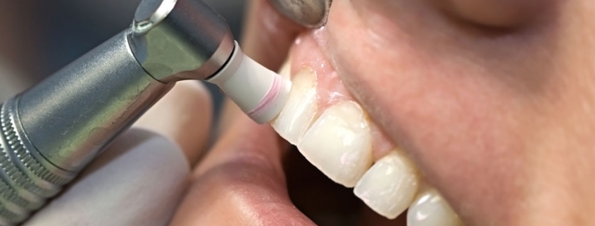 بروساژ در کلینیک دندان پزشکی تبسم مهر