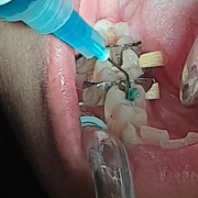 مراحل پر کردن دندان ها