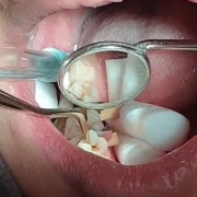 پر کردن دندان ها با آمالگام یا مواد همرنگ